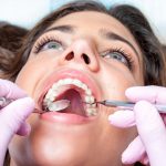 Inactivación de Caries