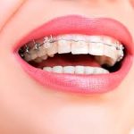 Ferulización Periodontal