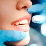 Regularización de Reborde Alveolar